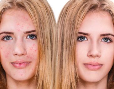 Come Riconoscere L Acne Da Stress E Combatterla In Modo Efficace