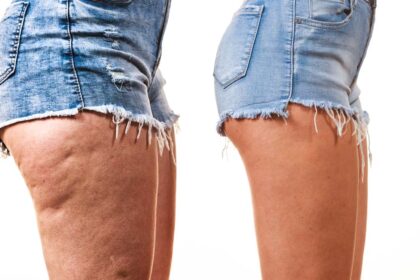 Confronto tra gambe femminili cosce con e senza cellulite